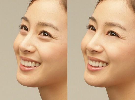 Bóc mỡ mắt nội soi là gì