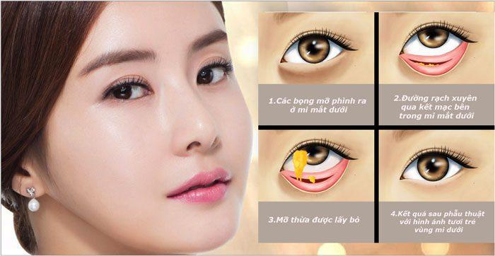 Các nguyên nhân gây ra mỡ thừa trên mí mắt
