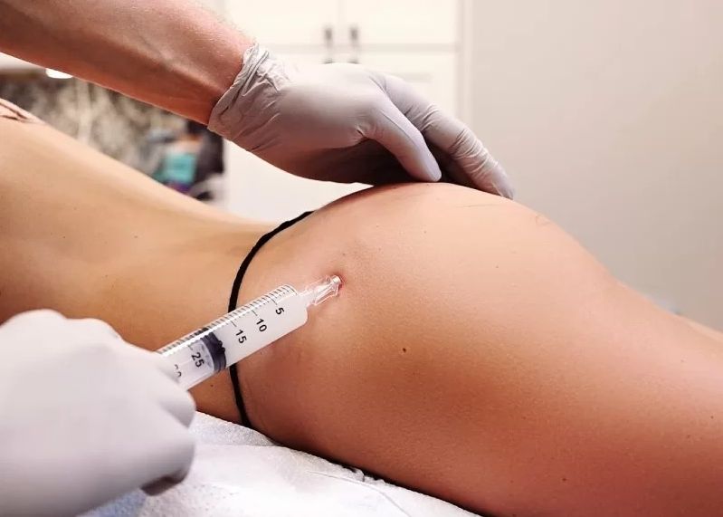 Cấy mông bằng mỡ tự thân
