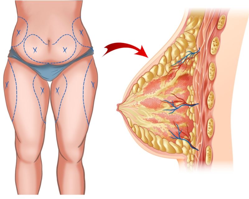 Cấy ngực bằng mỡ tự thân