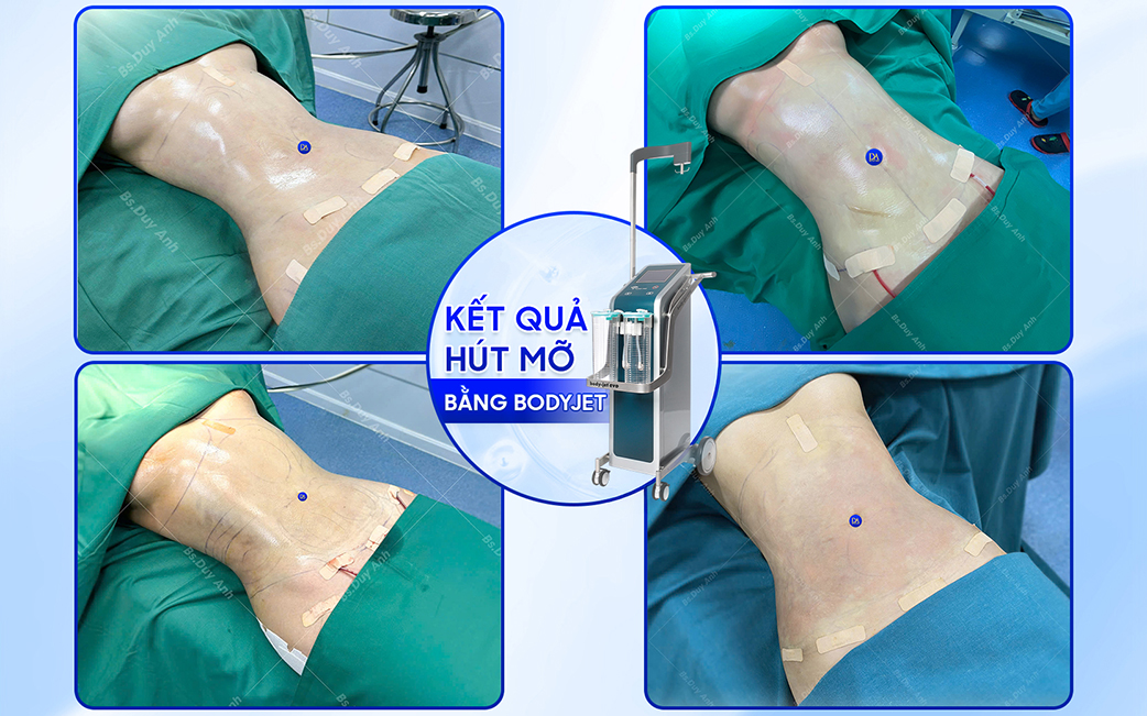 Dáng bụng sau khi được hút mỡ bằng công nghệ Body Jet