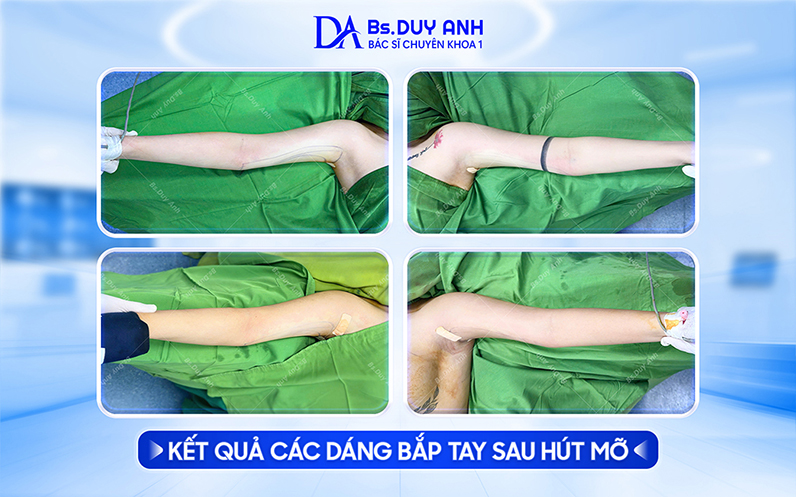 Kết quả sau khi hút mỡ bắp tay của khách hàng tại BS. Võ Duy Anh