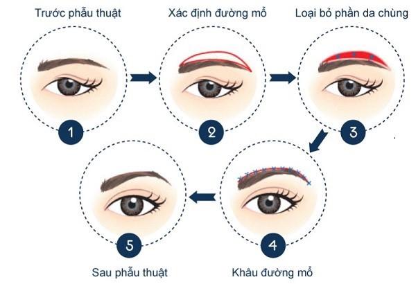 Nâng cung chân mày ở đâu đẹp tại TP.Hồ Chí Minh