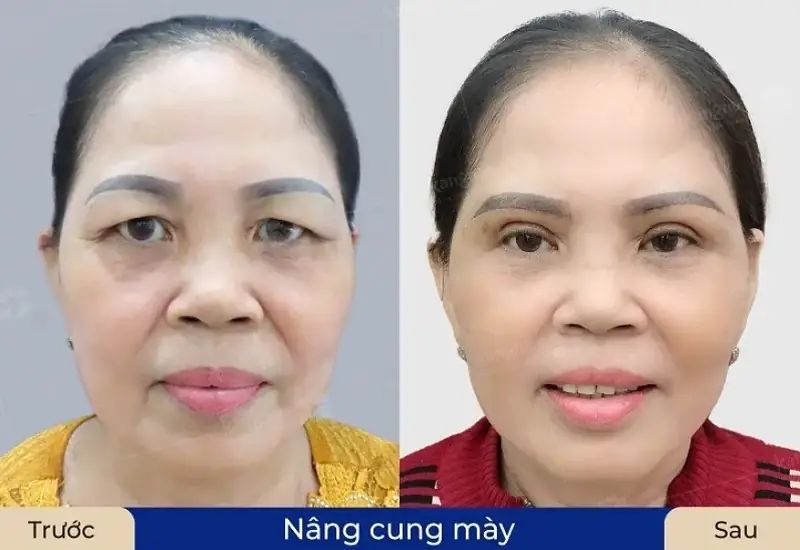 Nâng cung chân mày sẽ giúp chị em tìm lại vẻ đẹp thanh xuân.