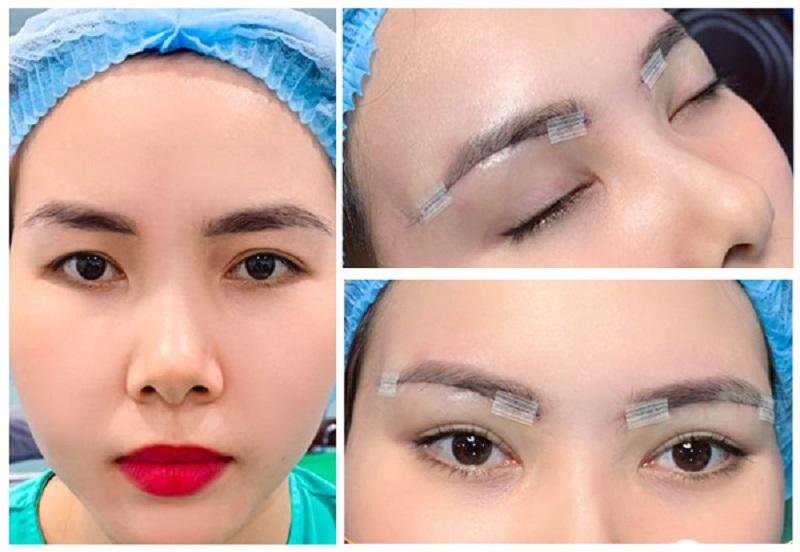 Phương pháp nâng cung chân mày bằng phẫu thuật