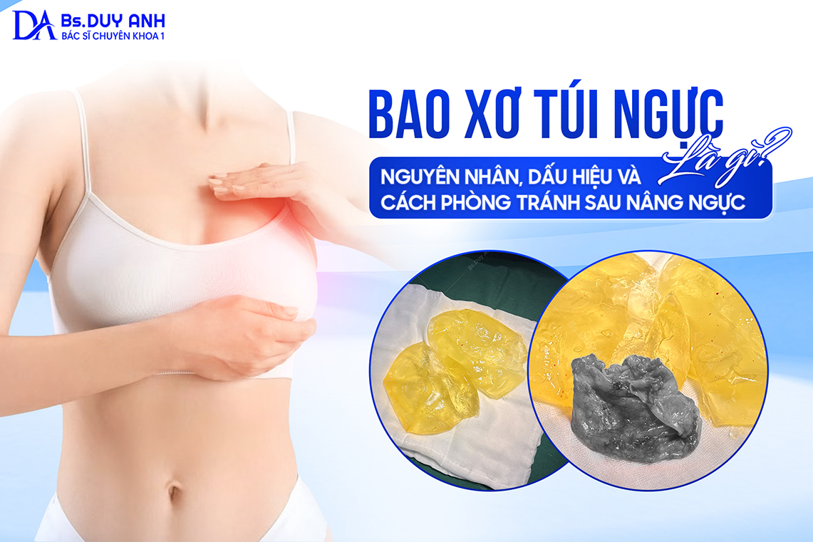 Bao xơ túi ngực là gì? Nguyên nhân, dấu hiệu và cách phòng tránh sau nâng ngực