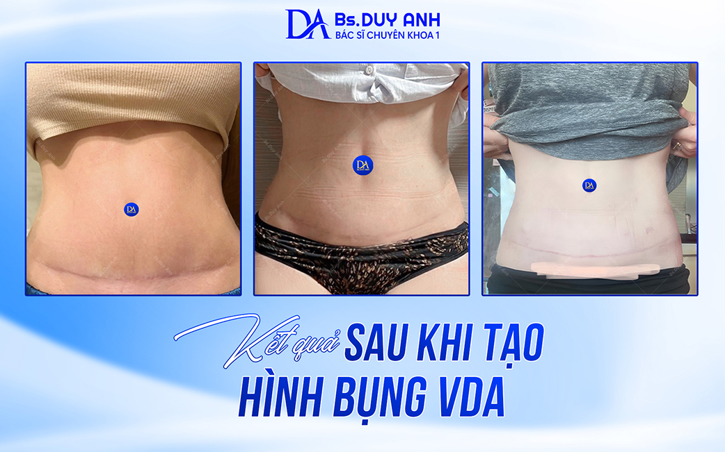 Các dáng bụng sau khi đã thực hiện tạo hình VDA