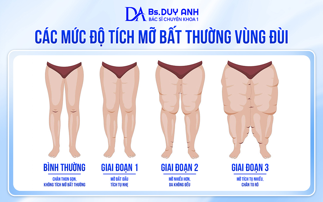 Các mức độ tích mỡ vùng đùi