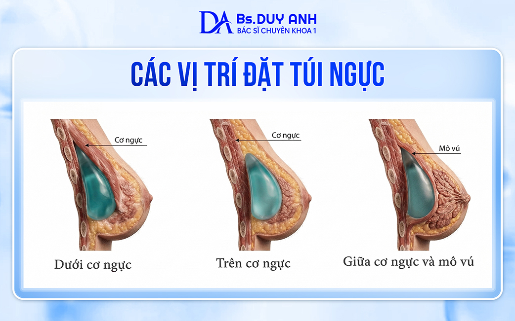 Các vị trí đặt túi ngực phổ biến