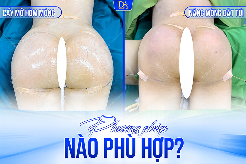 Cấy mỡ hõm mông hay nâng mông nội soi đặt túi: Phương pháp nào phù hợp?