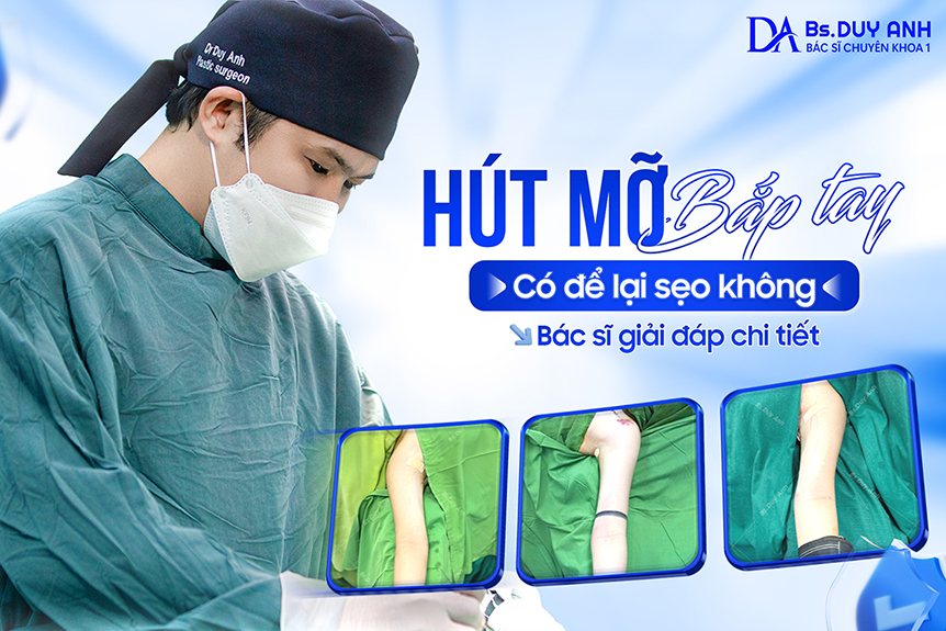 Hút mỡ bắp tay có để lại sẹo không? Bác sĩ giải đáp chi tiết