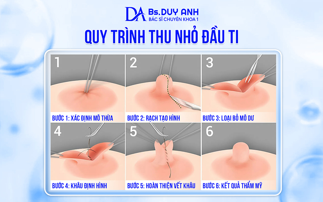 Quy trình thu nhỏ đầu ti