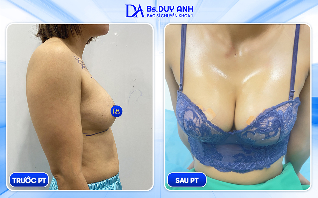 Hình minh họa ngực chảy xệ sau sinh trước và sau khi phẫu thuật (before – after)