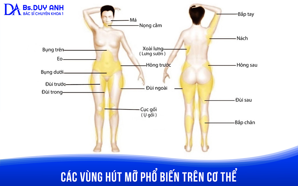 Sơ đồ các vùng hút mỡ phổ biến trên cơ thể