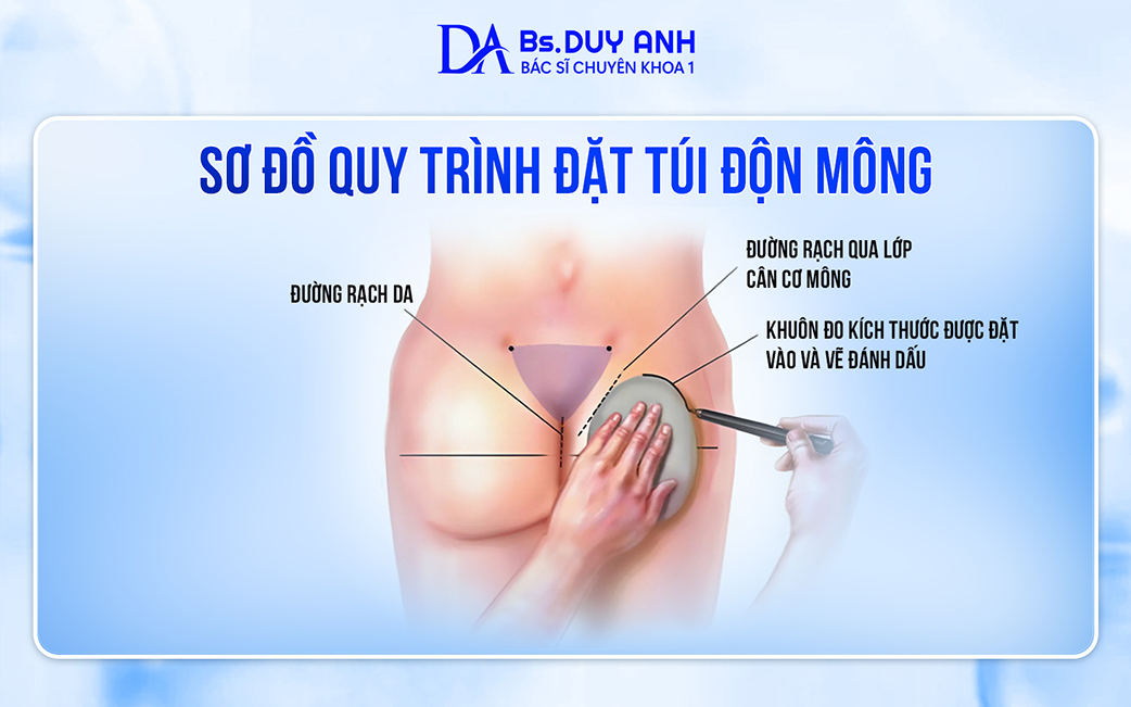 Khái quát sơ đồ quy trình đặt túi độn mông