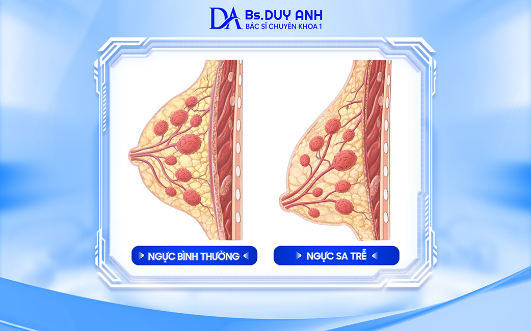 So sánh ngực bình thường và ngực sa trễ