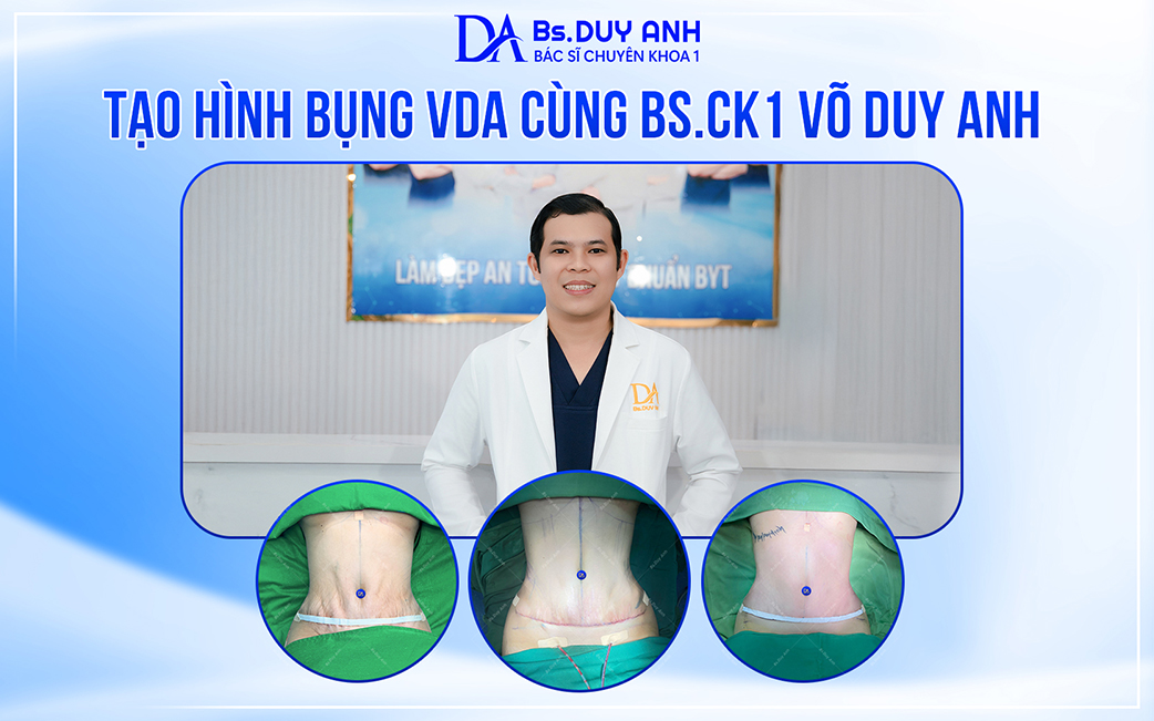 Tư vấn tạo hình bụng VDA an toàn & uy tín tại TP.HCM cùng Bs. Võ Duy Anh