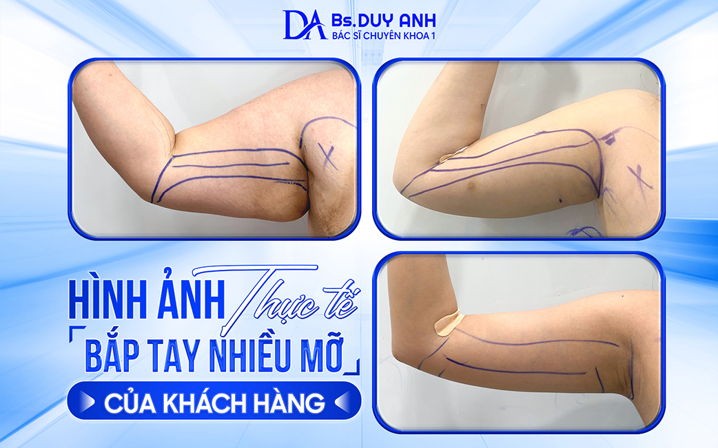 Tình trạng bắp tay nhiều mỡ của khách 