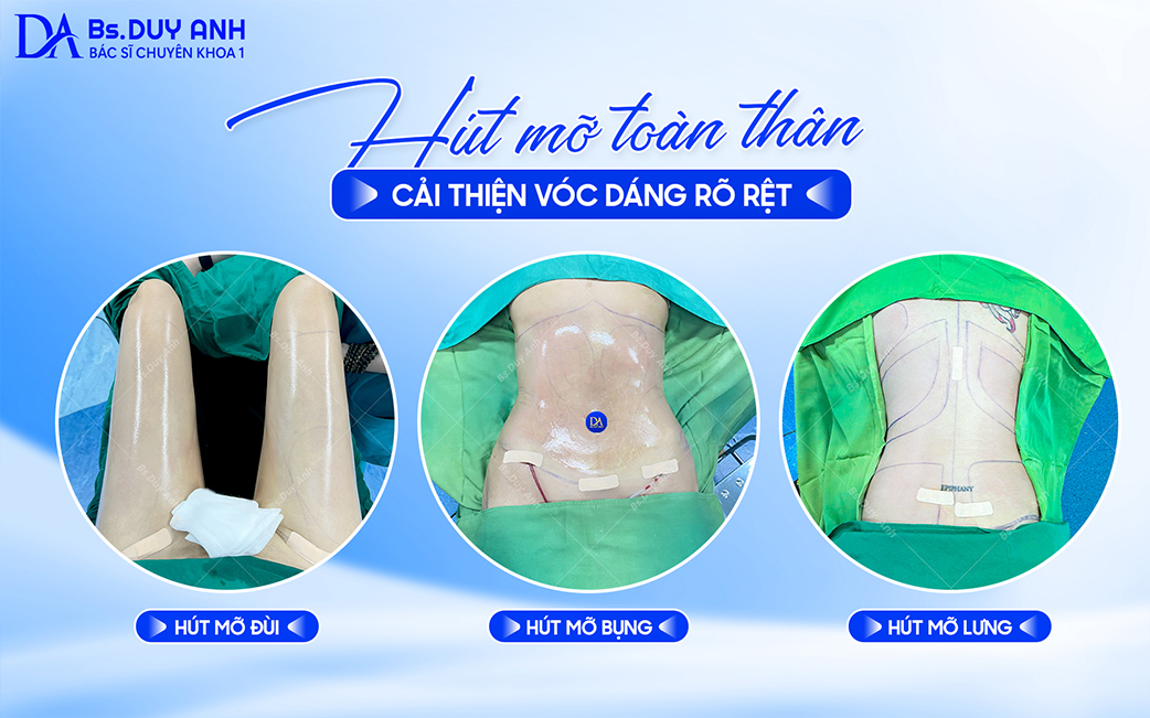 Before – after hút mỡ các vùng