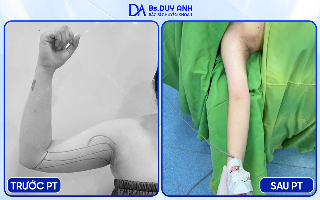 Hút mỡ bắp tay là một phần của hút mỡ body, giúp cánh tay thon gọn hơn