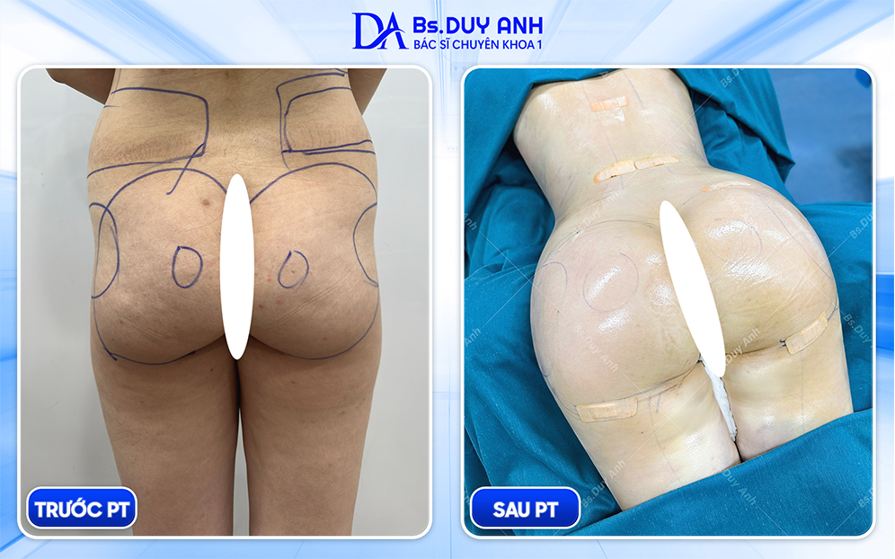 Hình ảnh trước và sau khi nâng mông của khách hàng