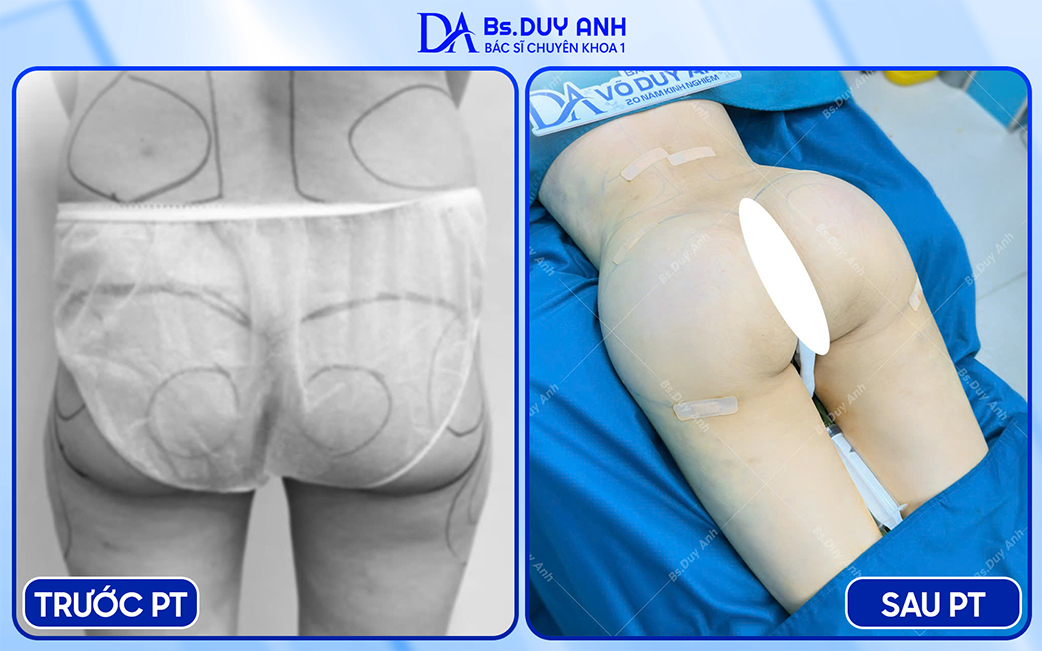Trước - sau nâng mông nội soi đặt túi