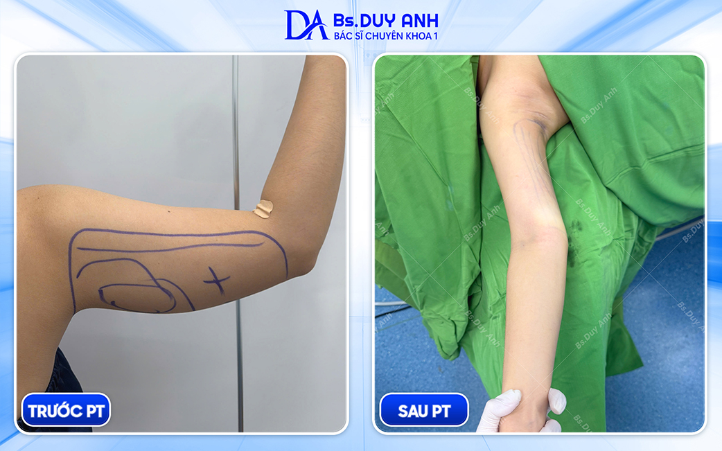 Trước & Sau khi hút mỡ bắp tay