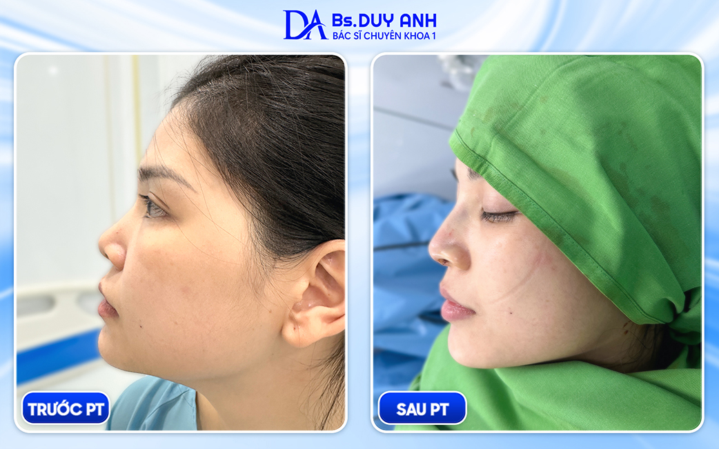 Trước và sau nâng mũi
