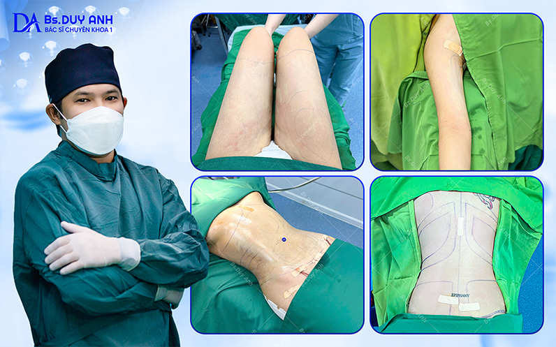 Tư vấn hút mỡ toàn thân an toàn & hiệu quả cùng Bs. CKI Võ Duy Anh