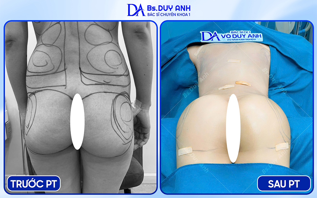 Kết quả trước – sau nâng mông, form ban đầu đã được định hình, kết quả sẽ tiếp tục ổn định trong quá trình hồi phục