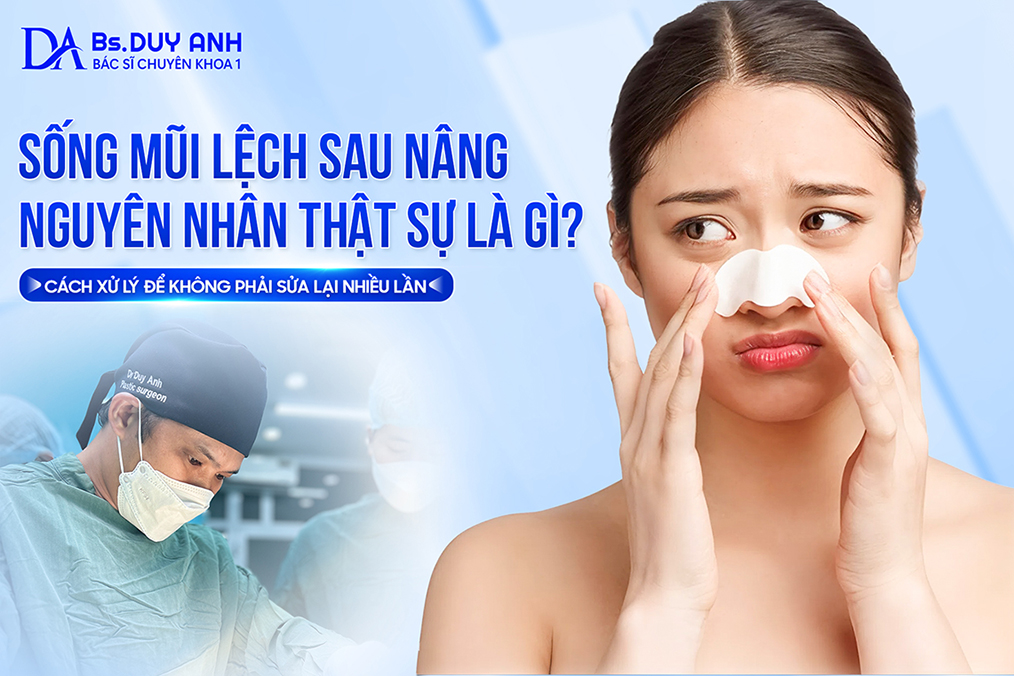 Sống Mũi Lệch Sau Nâng: Nguyên Nhân Thật Sự Là Gì? Cách Xử Lý Để Không Phải Sửa Lại Nhiều Lần