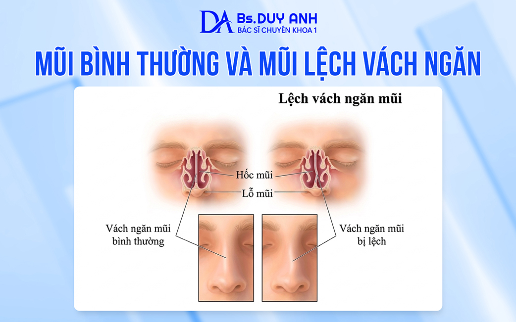 Sự khác nhau giữa mũi bình thường và mũi lệch vách ngăn