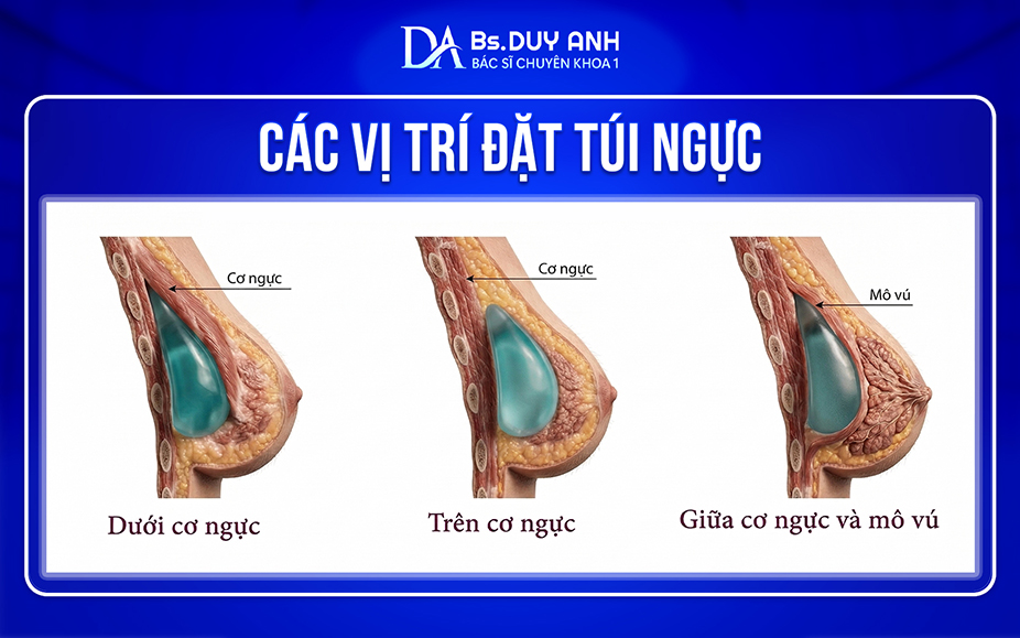 Các vị trí đặt túi ngực phổ biến hiện nay