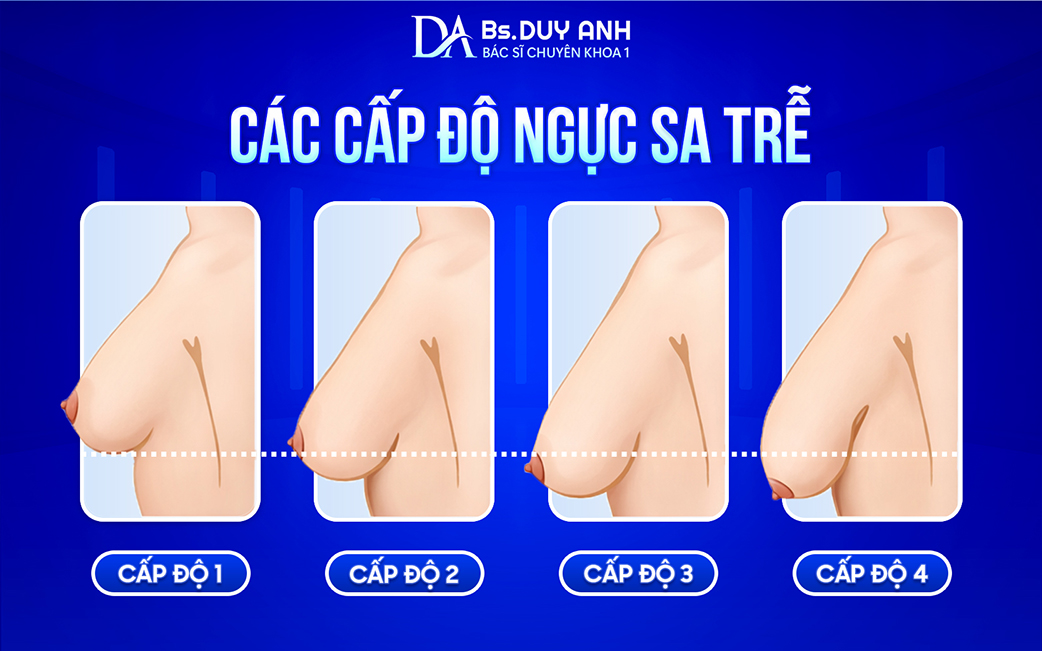Dấu hiệu nhận biết ngực sa trễ theo từng cấp độ