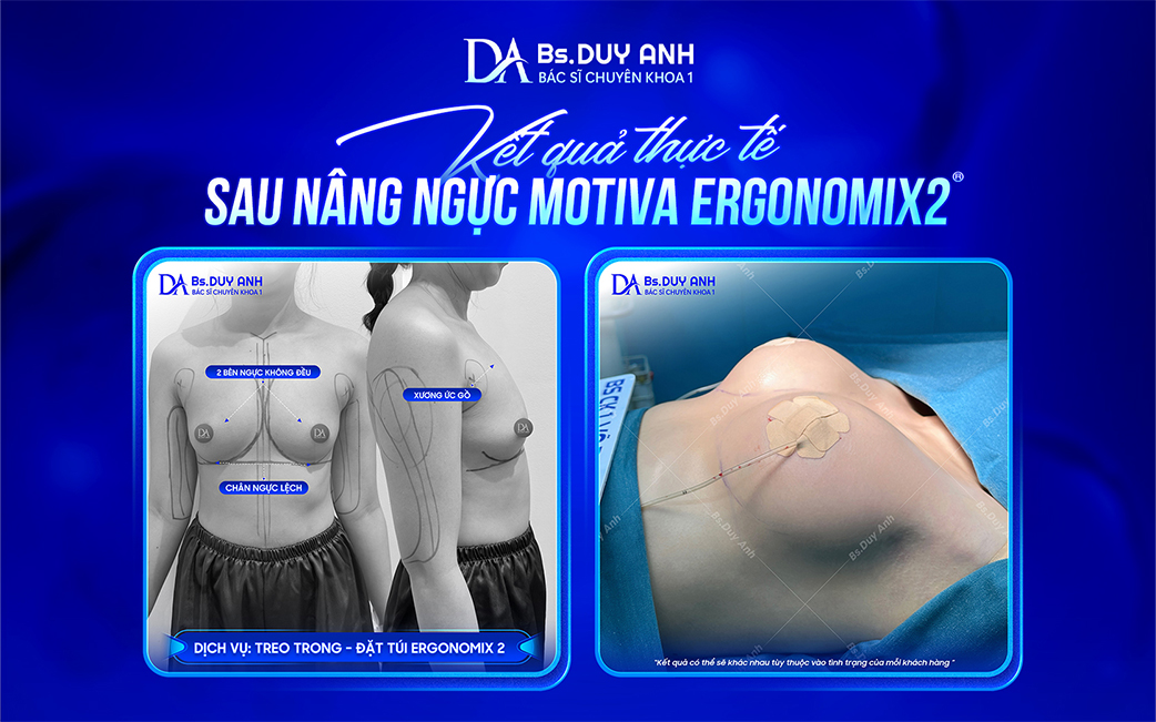 Dáng ngực thực tế sau nâng ngực bằng túi Motiva Ergonomix2®
