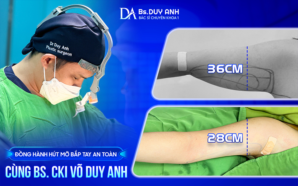 Đồng hành cải thiện bắp tay thon gọn cùng BS. CKI Võ Duy Anh