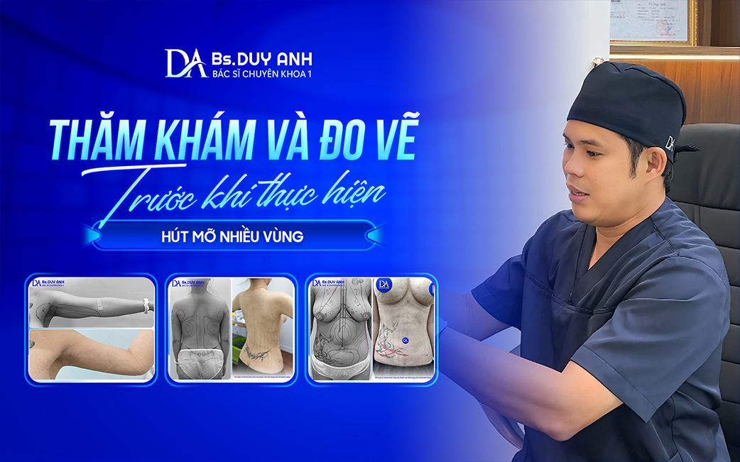 Thực hiện đo vẽ và xác định vùng hút mỡ