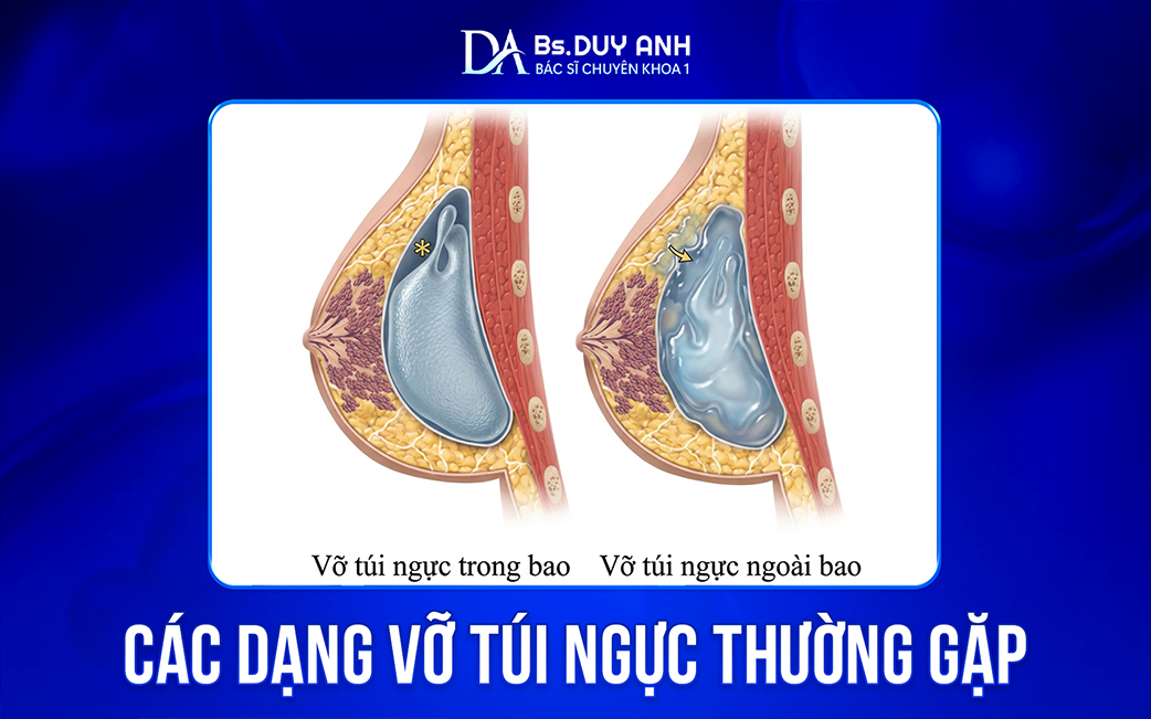 Các trường hợp vỡ túi ngực thường gặp