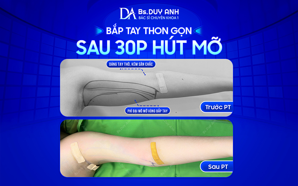 Hiệu quả cải thiện bắp tay sau hút mỡ