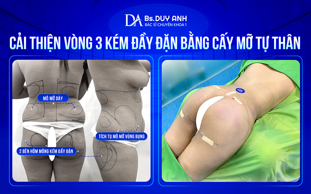 Kết quả cải thiện vòng 3 bằng cấy mỡ tự thân