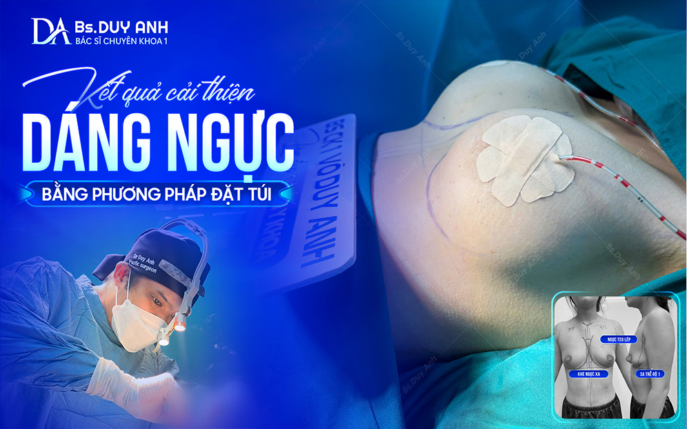 Kết quả thẩm mỹ vòng 1 sau nâng ngực bằng phương pháp đặt túi