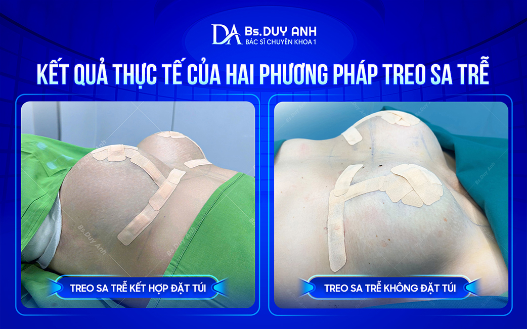 Kết quả thực tế của hai phương pháp treo sa trễ phổ biến