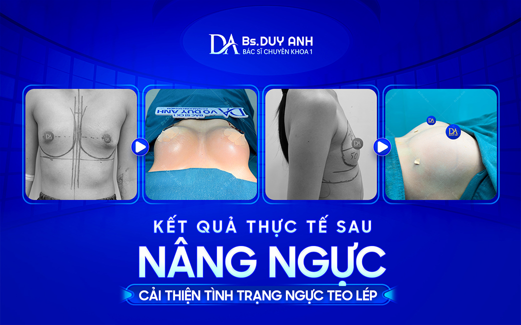 Kết quả thực tế sau nâng ngực, cải thiện tình trạng vòng 1 nhỏ, teo lép và thiếu cân đối