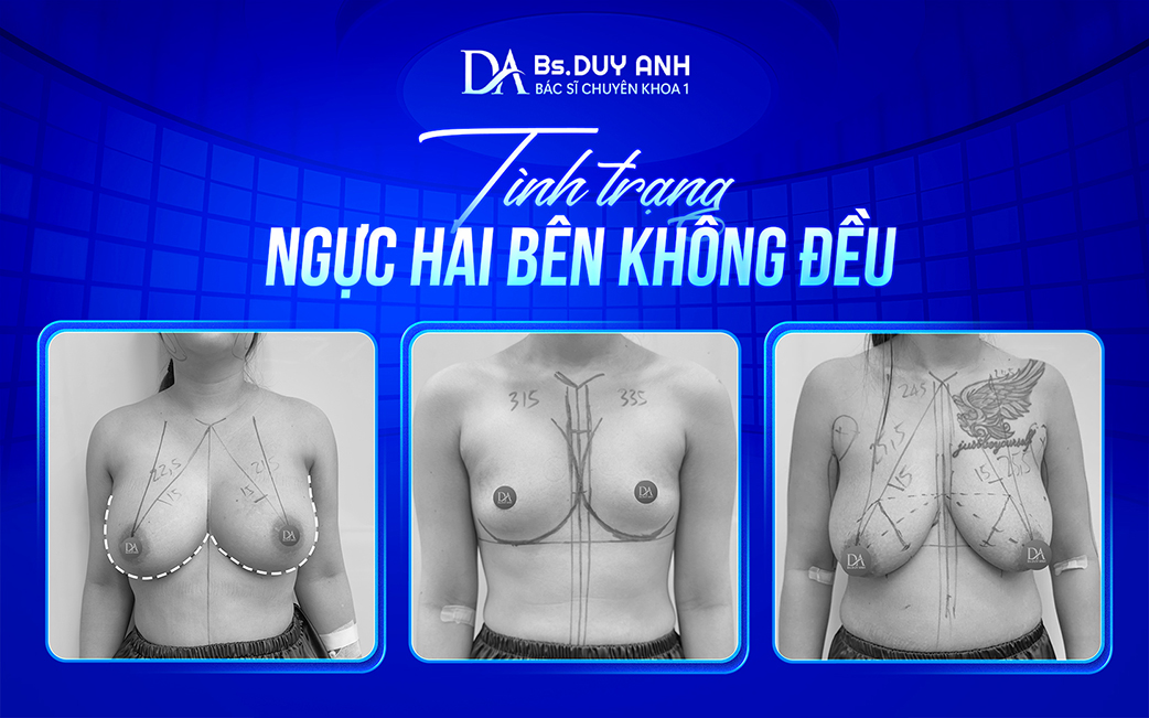 Ngực không cân xứng giữa hai bên