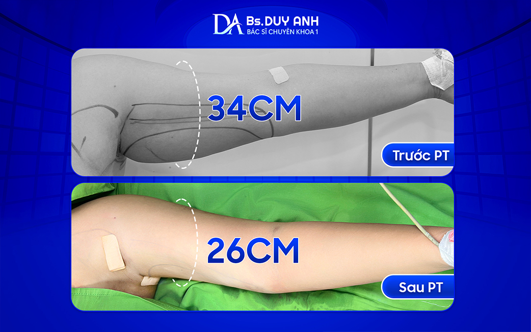 Số đo bắp tay trước và sau hút mỡ