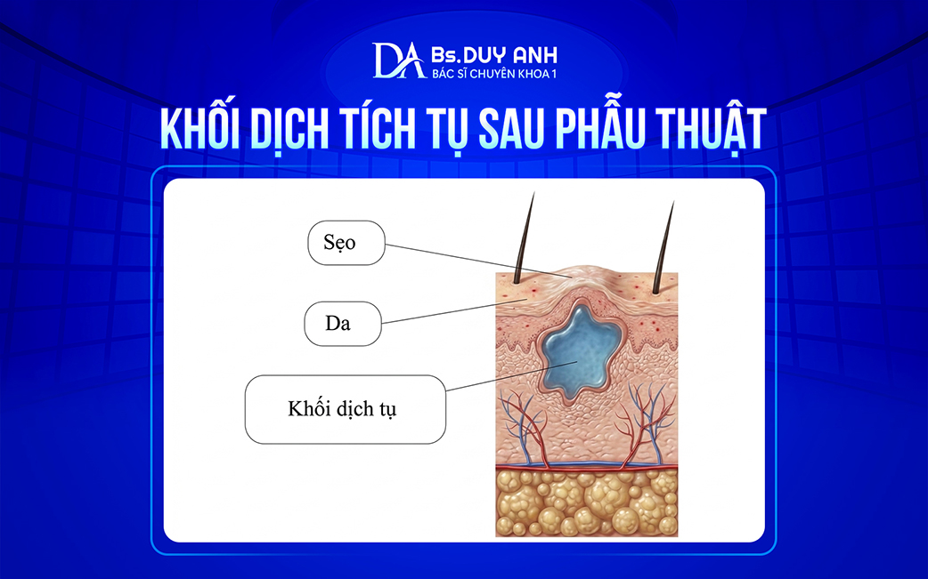 Tình trạng tụ dịch sau phẫu thuật