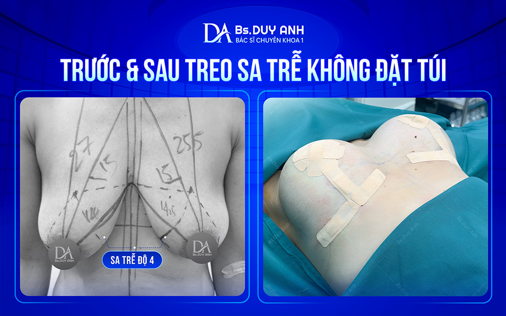 Kết quả thực tế sau treo sa trễ không đặt túi
