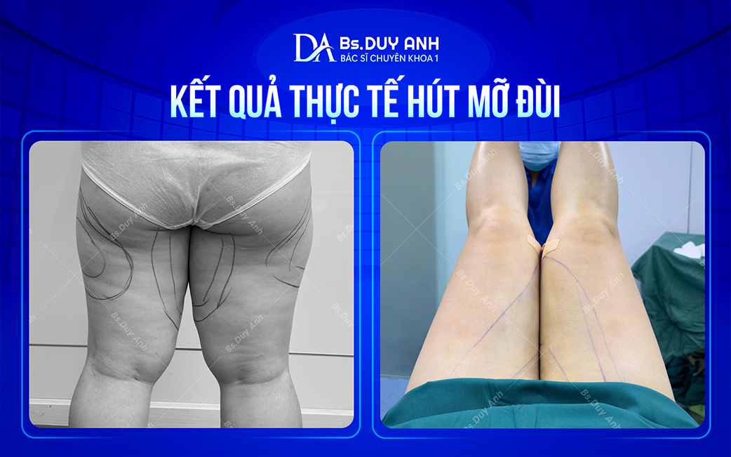 Trước và sau khi hút mỡ đùi
