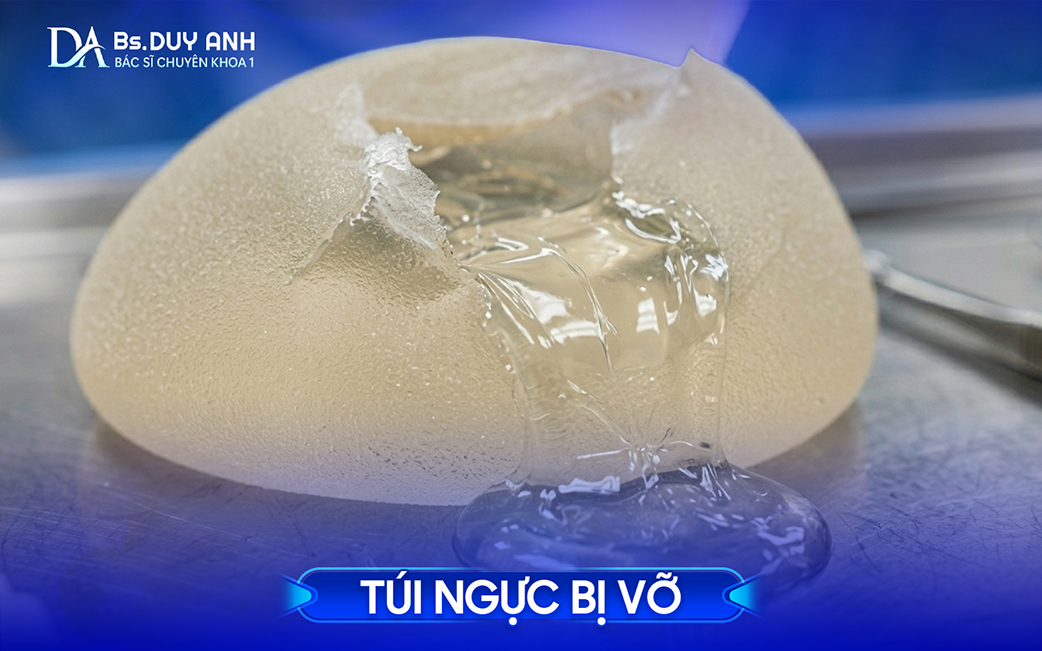 Túi ngực bị vỡ, gel silicone thoát ra ngoài lớp vỏ túi