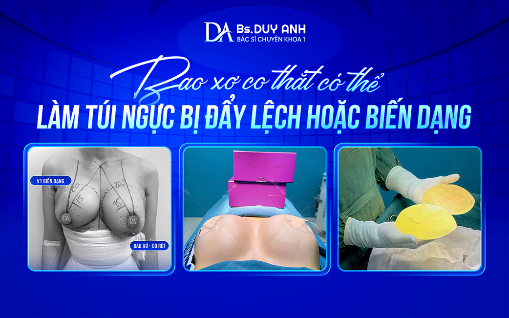 Bao xơ co thắt có thể gây xô lệch túi ngực, ảnh hưởng đến tính thẩm mỹ